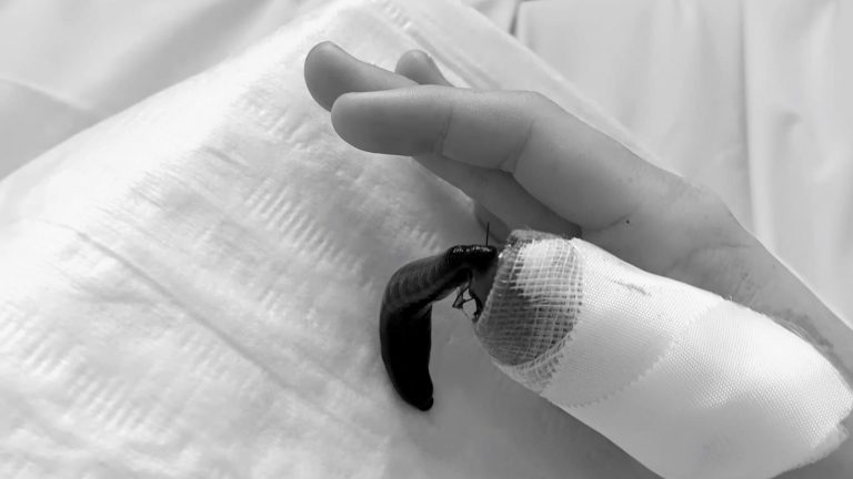 Görlitz: Rettung durch Blutegeltherapie im Klinikum